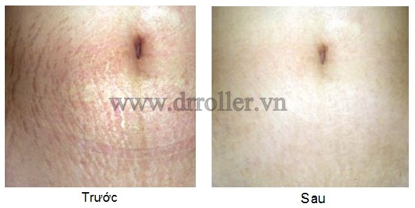 Hình ảnh điều trị rạn da bằng kim lăn Dr. Roller Hàn Quốc