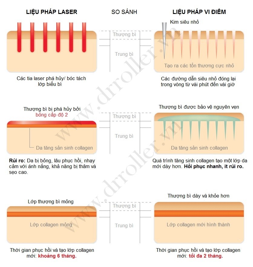 So sánh các phương pháp trị sẹo lõm sẹo rỗ
