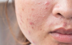 Bỏ ngay 6 thói quen nhiều người mắc phải để mặt không nổi đầy mụn